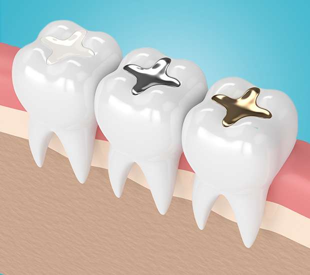 Glendale Tooth Colored Fillings